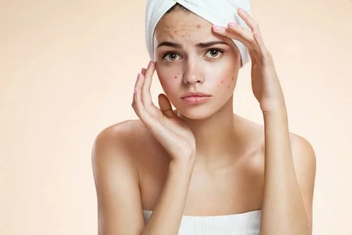 Treat Your Acne With Friendly Acne Manag