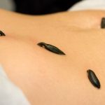 leech therapy